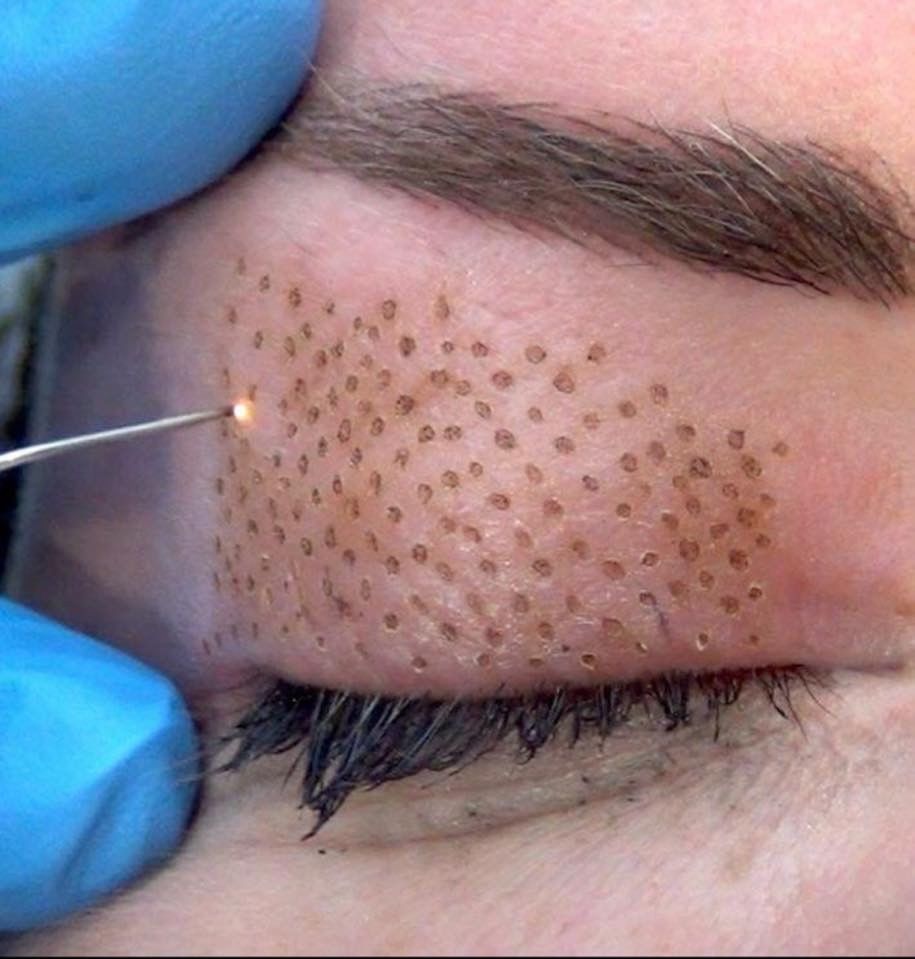 Plasmage Fibroblast Skin Tightening Plasmage Fibroblast Skin Tightening